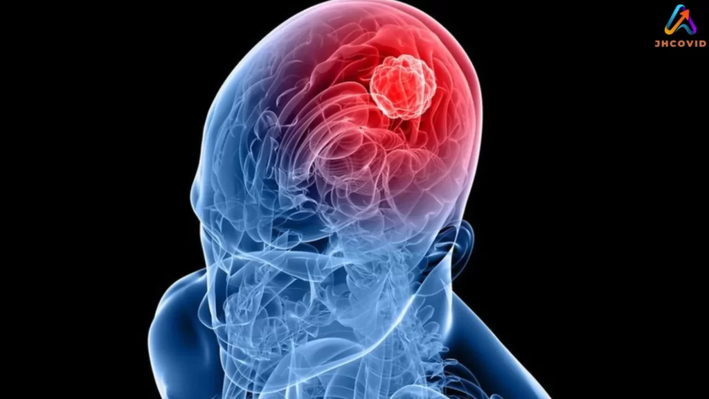 Glioblastoma 